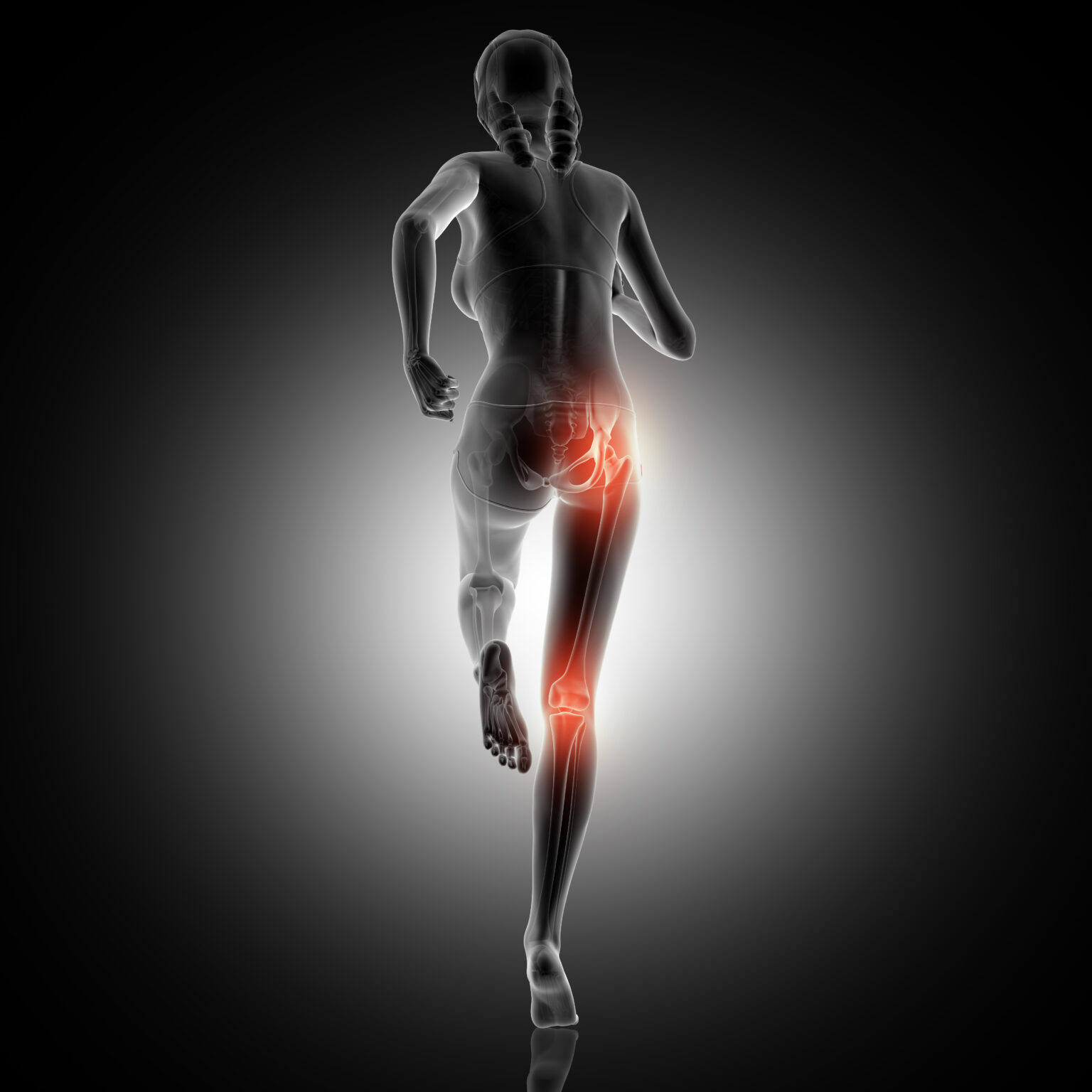 Sciatica – The Spine Expert